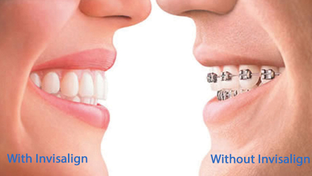 Invisalign in Hercules