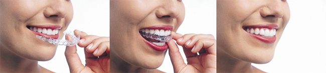 Hercules Invisalign