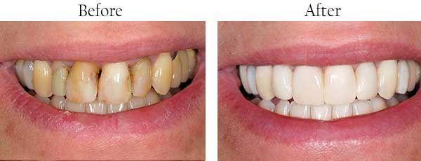 Before and After Teeth Whitening in Hercules