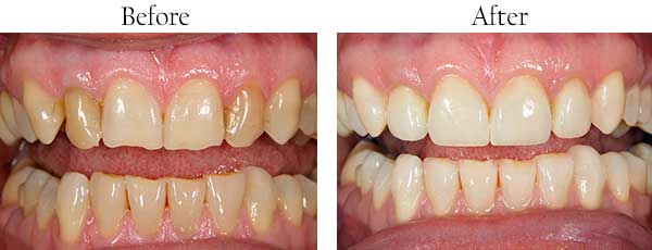 Before and After Invisalign in Hercules