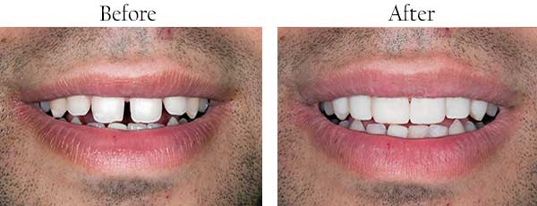 Before and After Dental Implants in Hercules