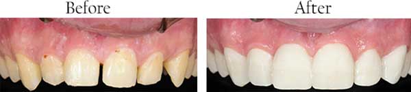 Hercules Before and After Invisalign