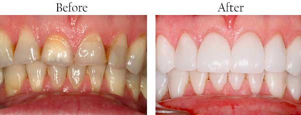 Hercules Before and After Dental Implants