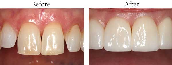Hercules Before and After Teeth Whitening