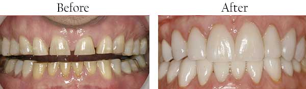Before and After Veneers in Hercules