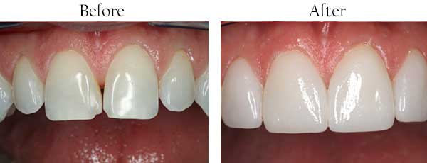 Hercules Before and After Dental Fillings