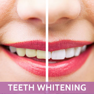 Teeth Whitening in Hercules